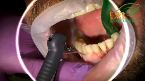 Передовое лечение пародонтита в Екатеринбурге