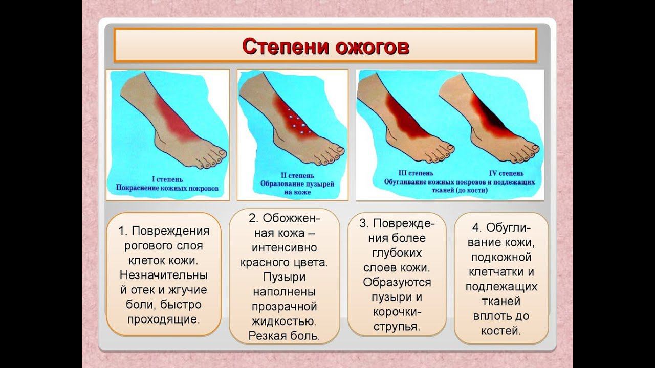 ОБЖ. Доврачебная помощь. Ожоги. Первая помощь при ожогах