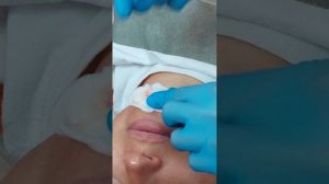 DMAE LIFT ELDERMAFILL. КАНЮЛЬНАЯ ТЕХНИКА.