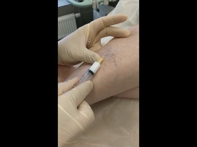 Лечение сосудистых звездочек склеротерапией
