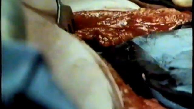 Хирургия ожоговых стриктур пищевода. Пластика пищевода  Treatment of burn esophageal strictures