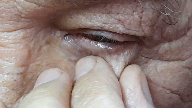 Массаж мейбомиевых желез поможет устранить синдром сухости глаз.