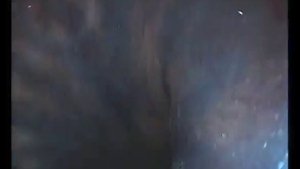 Низкодифференцированный рак желудка в молодом возрасте.