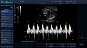 Измерение ЧСС плода в режиме PW, II триместр