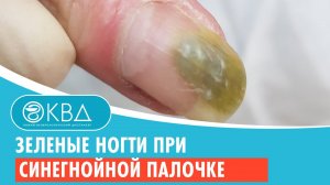 ? Зеленые ногти при синегнойной палочке. Клинический случай №248
