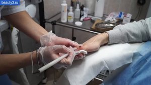 Удаление бородавок методом электрокоагуляция