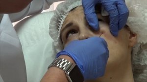 Коррекция латеральной части периорбитальной области