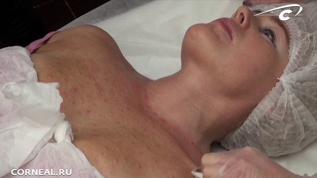 Сколько мл препарата уходит на зону декольте? смотреть онлайн