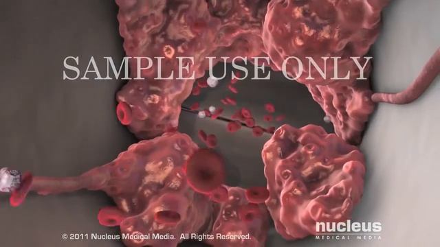 Атеросклероз смотреть онлайн