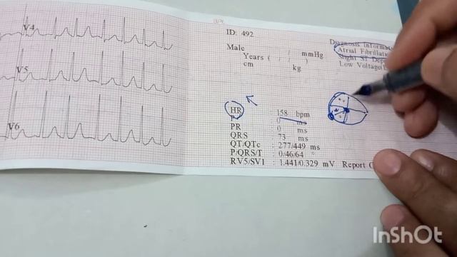 Atrial Fibrillation/ Fibrillatory waves/ Abnormal heart rhythm/ P wave absent in ECG смотреть онлайн
