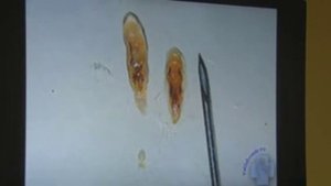 #Описторх двуустка кошачья и Описторхоз