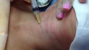 Мезотерапия Обучение Шея Морщины Ожерелья