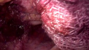 Рецидивный пролапс прямой кишки после задней ректосакропексии