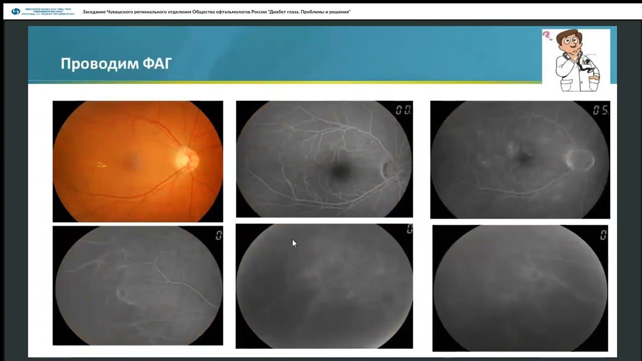 Заседание ЧООР Общества офтальмологов России. Диабет глаза. Проблемы и решения. 19.05.23 смотреть онлайн