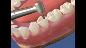 Культевая вкладка. Что это такое и как ее изготовить. Ортопедическая стоматология.