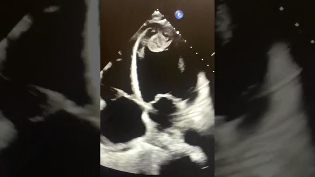 ECHO Left ventricular Clot