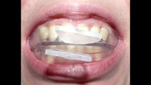 Скрежет зубов