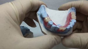 Частично съёмный нейлоновый протез