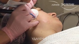 Удаление невуса