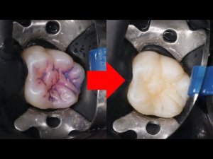 Лучший способ спасти постоянные зубы ребенка от кариеса