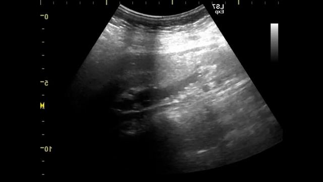 холедох камни смотреть онлайн