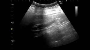 холедох камни