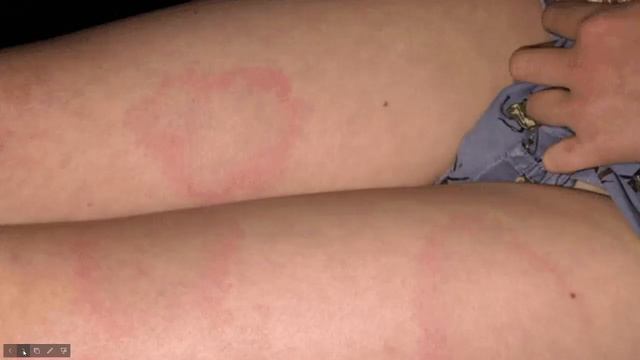 Нас вкусив кліщ!!! Що робити??? смотреть онлайн