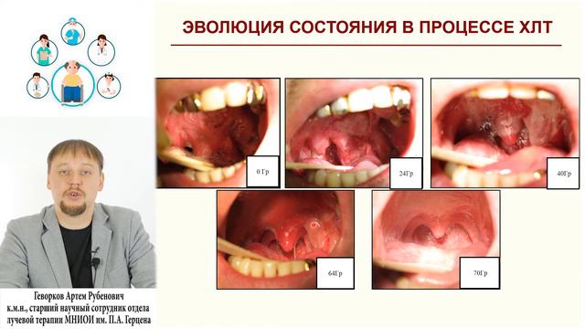 91. Нутритивная поддержка при лечении больных опухолями головы и шеи