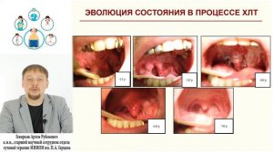 91. Нутритивная поддержка при лечении больных опухолями головы и шеи