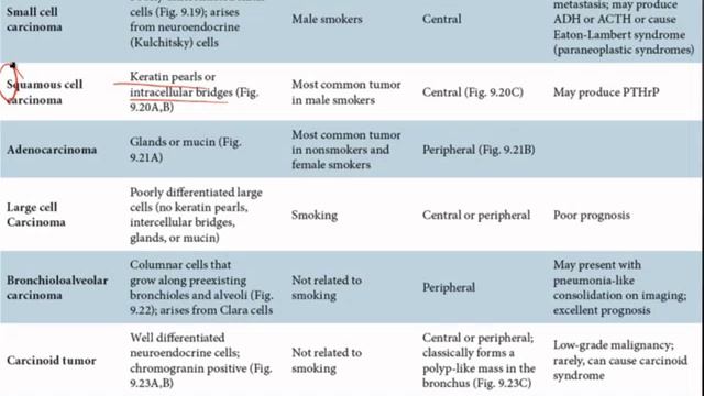 Pathoma USMLE - IX ГЛАВА - 6.Рак лёгких