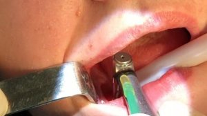 Удаление зубов на нижней челюсти с одномоментной дентальной имплантацией. Профессор Орлов А.А.