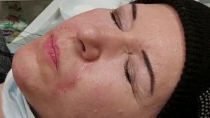 АирисКом студенты учатся: применение филлера для корекции носогубной складки и подбородка.