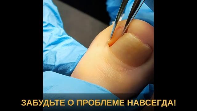 Удаление вросшего ногтя лазером смотреть онлайн