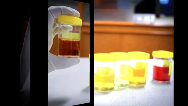 5 малозаметных симптомов рака поджелудочной железы, которые люди часто упускают