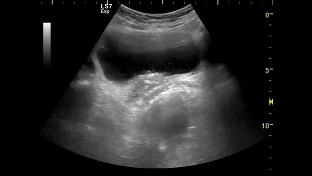 удвоение почки смотреть онлайн