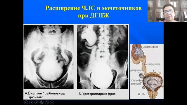 Доброкачественная гиперплазия предстательной железы смотреть онлайн