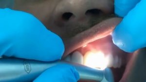 реставрация передних зубов