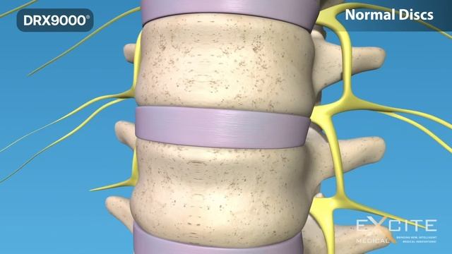 What is Spinal Decompression? DRX9000 for low back pain, sciatica and herniated disc. Avoid Surgery смотреть онлайн