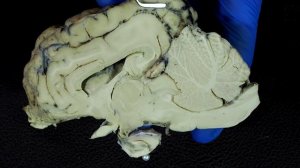 мозжечок. 4-й мозговой желудочек.