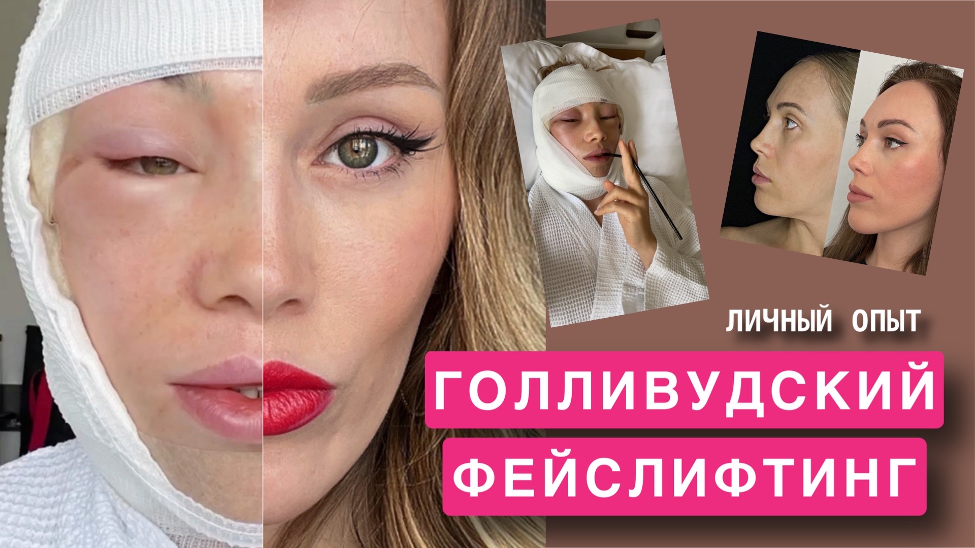 Голливудский ФЕЙСЛИФТИНГ, почему я решилась на ПЛАСТИЧЕСКУЮ ОПЕРАЦИЮ
