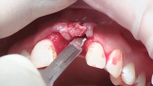 17 января 2014. Мария Александровна Носова. Эпизод 2. Пластика десны. смотреть онлайн