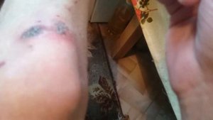 Лучшее заживление раны....