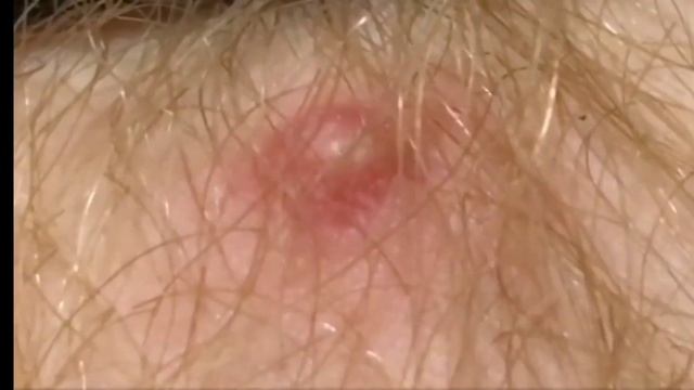 прыщ в носу / прыщи на носу смотреть онлайн