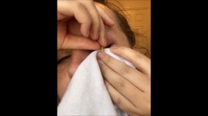 самостоятельное удаление огромного гнойника с века