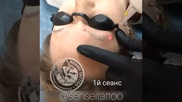 ВЫВЕДЕНИЕ ЛАЗЕРОМ НЕКАЧЕСТВЕННОГО ТАТУАЖА БРОВЕЙ И СТРЕЛОК