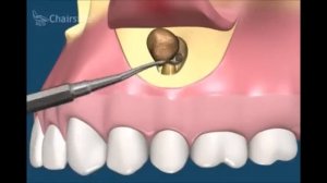 Хирургическая стоматология  Удаление большой кисты с соустъем с гайморовой пазухой