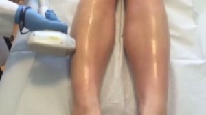 A Behind the Scenes Look at Laser Hair Removal at Wisconsin Vein Center & Medispa