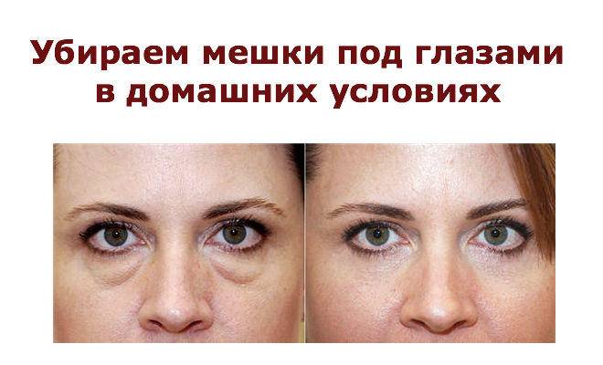 Как быстро снять сильные отеки