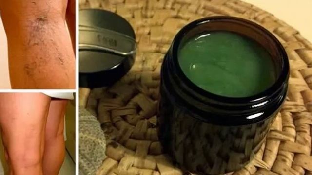 Как избавиться от варикоза с помощью этого рецепта. смотреть онлайн