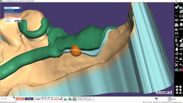 EXOCAD PartialCAD моделировка бюгеля на нижнюю челюсть смотреть онлайн